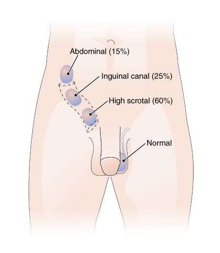 Drawing showing an undescended testis in a child