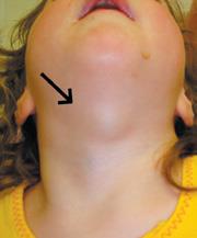 Illustration of a thyroglossal duct cyst in the midline of the neck