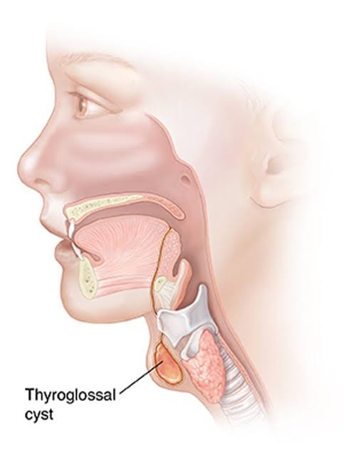 Clinical image showing a thyroglossal duct cyst swelling in the neck